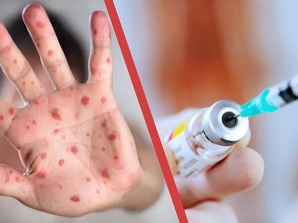 Qizamiq —  bu oʻtkir yuqumli virusli kasallik boʻlib, havo-tomchi yoʻli orqali yuqadi.